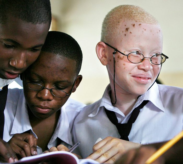 Albinism-Support-project-in-Tanzania